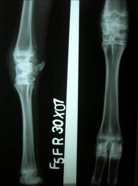 xray osteofluorosis