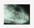 dental abscess osteomyelitis