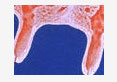 teat fibrosis homeopathic3
