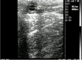 Ovarian Follicle 