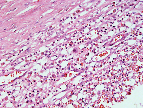 Histopathological sections of lung showing extensive tissue reaction along with inflammatory cells infiltrate around the necrotic areas