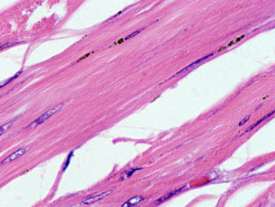 Cyst wall showing laminated membrane