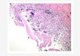 hydatid disease