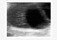 ovary sonography