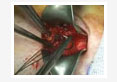 Umbilical Hernia with Abomasal-Umbilical Fistula in a Cow Calf