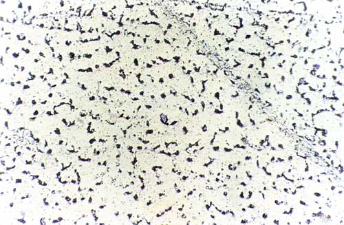 Candida mastitis Fig 3