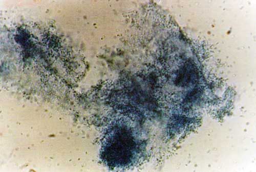 Candida Mastitis Fig 5